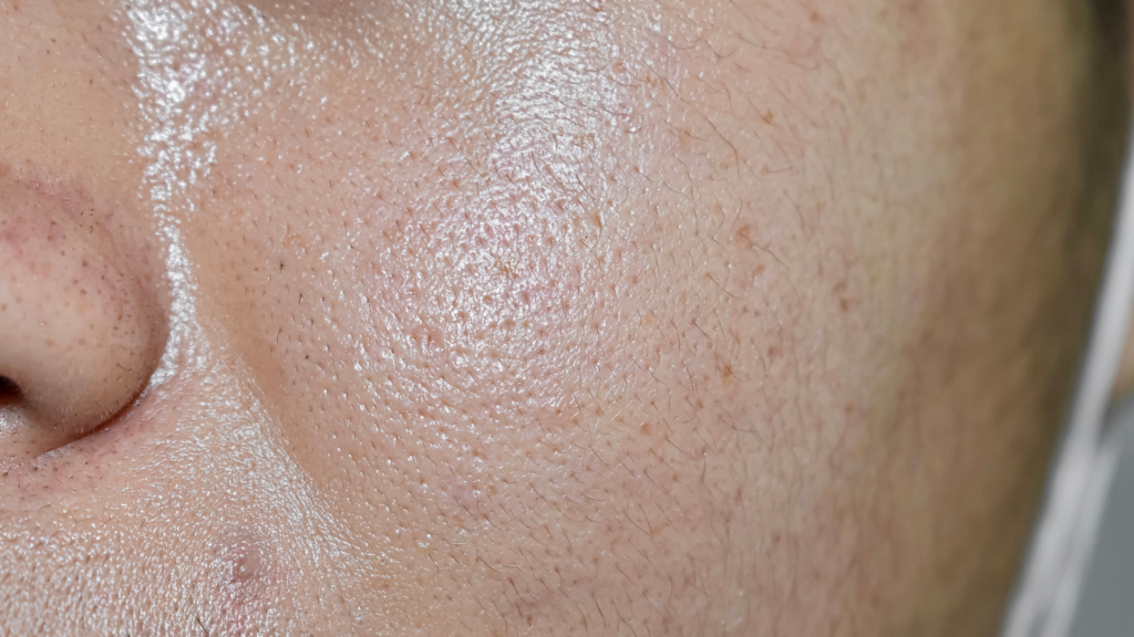 Nærbillede af fedtet hud med synlige porer — sebum-rebound i aktion